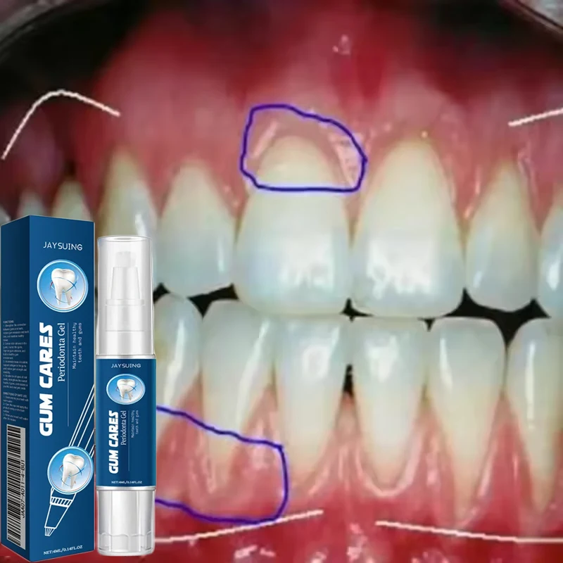 손상된 잇몸 리페어 케어 젤, 잇몸 통증 완화, 알레르기 딥 클리닝 치아 얼룩 치석 세럼, 치과 충치 치약